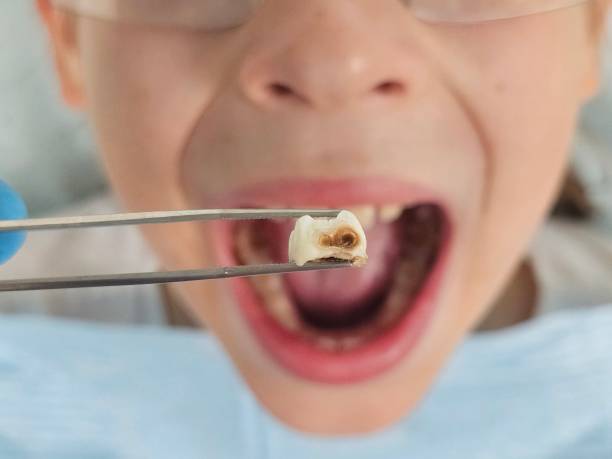Best Emergency Dental Care for Broken or Chipped Teeth in South Padre Island, TX